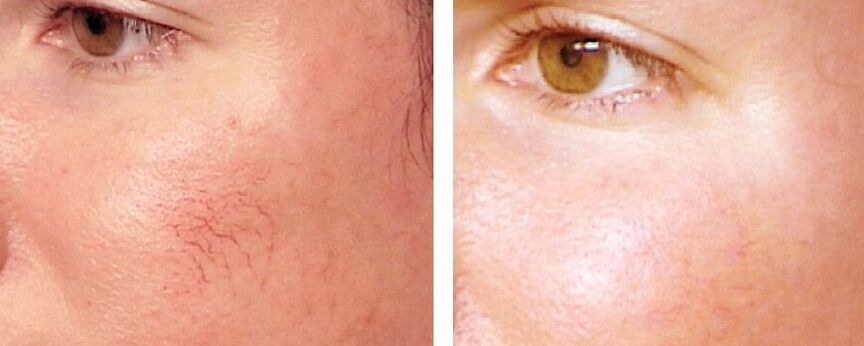 Pagtangtang sa Rosacea