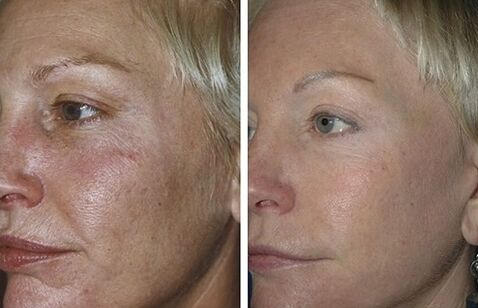 fractional laser rejuvenation sa wala pa ug human sa mga litrato