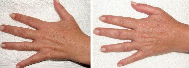 Resulta sa pagtangtang sa pigment spots sa mga kamot